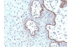 Formalin-fixed, paraffin-embedded human cervical carcinoma stained with c-Myc antibody (9E10. (c-MYC anticorps)