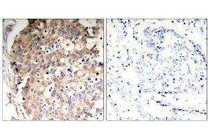 Immunohistochemical analysis of paraffin-embedded human breast carcinoma tissue, using SHP-1 (Phospho-Tyr536) Antibody (E011318). (SHP1 anticorps  (pTyr536))