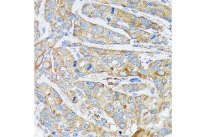 Immunohistochemistry of paraffin-embedded human esophageal cancer using Cytokeratin 1 (KRT1) (KRT1) Rabbit mAb (ABIN7268085) at dilution of 1:100 (40x lens). (Cytokeratin 1 anticorps)