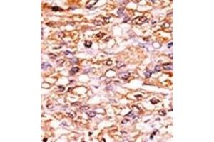 Formalin-fixed and paraffin-embedded human cancer tissue reacted with the primary antibody, which was peroxidase-conjugated to the secondary antibody, followed by AEC staining. (CDKN1B anticorps  (pSer178))