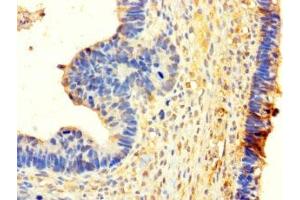 Immunohistochemistry of paraffin-embedded human ovarian cancer using ABIN7155505 at dilution of 1:100 (WHSC1L1 anticorps  (AA 1-645))