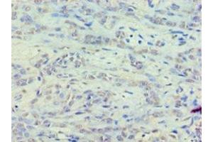 Immunohistochemistry of paraffin-embedded human breast cancer using ABIN7152122 at dilution of 1:100 (EEF1E1 anticorps  (AA 2-174))