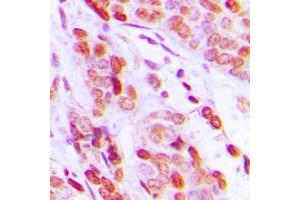 Immunohistochemical analysis of DAXX staining in human breast cancer formalin fixed paraffin embedded tissue section. (DAXX anticorps  (C-Term))