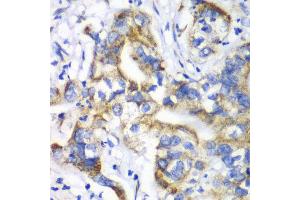 Immunohistochemistry of paraffin-embedded human liver cancer using RPL9 antibody at dilution of 1:100 (x40 lens). (RPL9 anticorps)