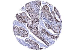 Esophagus Squamous cell carcinoma with strong SOX9 immunostaining of most tumor cells (Recombinant SOX9 anticorps  (AA 393-508))