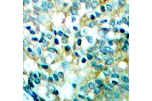 Immunohistochemistry of paraffin-embedded human breast carcinoma tissue, using Phospho-SRC-Y418 antibody (ABIN5969963). (Src anticorps  (pTyr418))