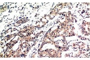 Immunohistochemistry of paraffin-embedded Human breast carcinoma tissue using Ubiquitin Monoclonal Antibody at dilution of 1:200. (Ubiquitin anticorps)