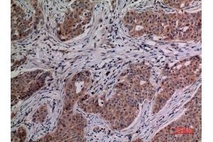 Immunohistochemical analysis of paraffin-embedded human-breast-cancer, antibody was diluted at 1:100. (IL-4 anticorps  (Internal Region))