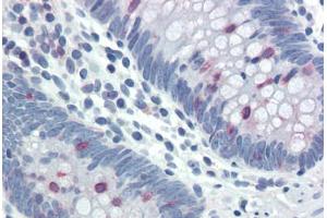 Human Colon (formalin-fixed, paraffin-embedded) stained with STAT5A/STAT5B antibody ABIN337157 at 20-40 ug/ml followed by biotinylated goat anti-rabbit IgG secondary antibody ABIN481713, alkaline phosphatase-streptavidin and chromogen. (STAT5 A/B anticorps  (pTyr694))