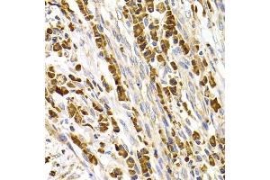 Immunohistochemistry of paraffin-embedded human stomach cancer using TACR3 antibody (ABIN5975101) at dilution of 1/100 (40x lens). (TACR3 anticorps)
