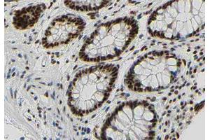 ABIN6267350 at 1/200 staining human colon carcinoma tissue sections by IHC-P. (Bcl-2 anticorps  (pSer87))
