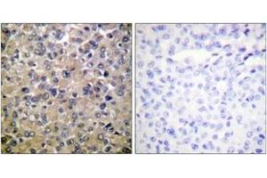 Immunohistochemistry analysis of paraffin-embedded human breast carcinoma tissue, using PP1-alpha (Ab-320) Antibody. (PPP1CA anticorps  (AA 281-330))