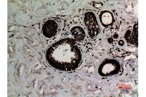 Immunohistochemistry (IHC) analysis of paraffin-embedded Human Breast Cancer, antibody was diluted at 1:100. (Histone 3 anticorps  (2meLys10))
