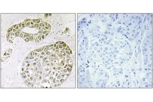 Immunohistochemistry analysis of paraffin-embedded human breast carcinoma tissue, using hnRNP M Antibody. (HNRNPM anticorps  (AA 11-60))