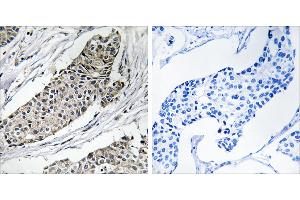 Peptide - +Immunohistochemistry analysis of paraffin-embedded human breast carcinoma tissue using KCNAB3 antibody. (KCNAB3 anticorps  (C-Term))