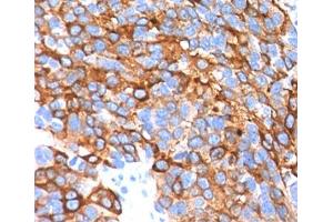 IHC testing in human melanoma stained with MART-1 antibody cocktail. (MLANA anticorps)