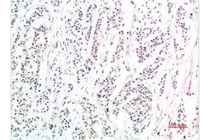 Immunohistochemical analysis of paraffin-embedded Human Stomach Carcinoma Tissue using Phospho-Smad3(S425) Mouse mAb diluted at 1:200. (Phospho-SMAD3(S425) (pSer425) anticorps)