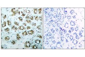 Immunohistochemical analysis of paraffin-embedded human breast carcinoma tissue, using NFκB-p65 (phospho-Ser311) antibody (E011260). (NF-kB p65 anticorps  (pSer311))