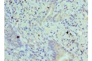 Immunohistochemistry of paraffin-embedded human lung cancer using ABIN7145292 at dilution of 1:100 (BIK anticorps  (AA 1-130))
