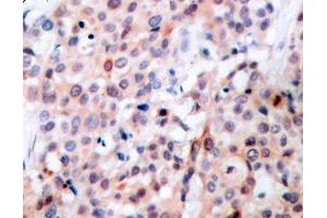 Immunohistochemistry of paraffin-embedded Human breast carcinoma tissue, using Phospho-Bcl-2(T56) Polyclonal Antibody (Bcl-2 anticorps  (pThr56))