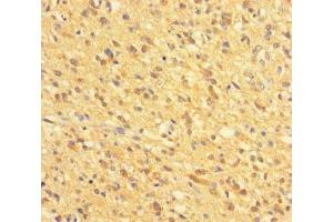 Immunohistochemistry of paraffin-embedded human glioma using ABIN7154018 at dilution of 1:100 (GATD3A (AA 43-268) anticorps)