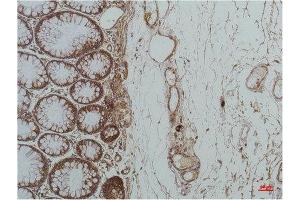 Immunohistochemistry (IHC) analysis of paraffin-embedded Human Colon Carcicnoma using GRP78/Bip Mouse Monoclonal Antibody diluted at 1:200. (GRP78 anticorps)