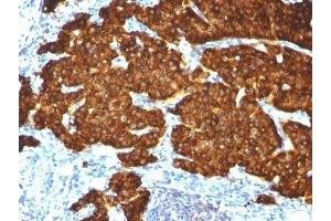 Formalin-fixed, paraffin-embedded pheochromocytoma stained with Chromogranin A antibody cocktail (Chromogranin A anticorps)