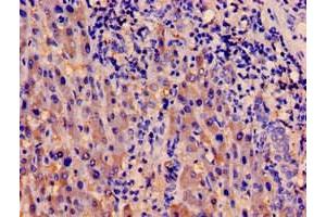 Immunohistochemistry of paraffin-embedded human liver cancer using ABIN7142002 at dilution of 1:100 (PDPK1 anticorps  (AA 294-432))