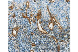 Immunohistochemistry of Human cervical cancer using CAV1 Polyclonal Antibody at dilution of 1:40 (Caveolin-1 anticorps)