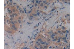 IHC-P analysis of Human Breast cancer Tissue, with DAB staining. (SLC9A3R2 anticorps  (AA 56-337))