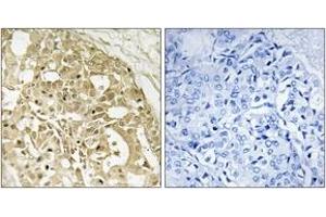 Immunohistochemistry analysis of paraffin-embedded human breast carcinoma tissue, using Catenin-beta (Ab-37) Antibody. (beta Catenin anticorps  (AA 3-52))