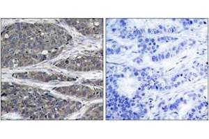 Immunohistochemistry analysis of paraffin-embedded human breast carcinoma tissue, using NF-kappaB p105/p50 (Ab-932) Antibody. (NFKB1 anticorps  (AA 899-948))
