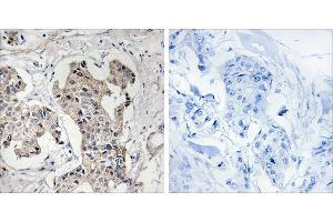 Peptide - +Immunohistochemistry analysis of paraffin-embedded human breast carcinoma tissue using BLK antibody. (BLK anticorps  (Internal Region))