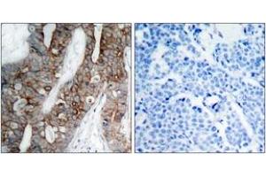Immunohistochemistry analysis of paraffin-embedded human breast carcinoma tissue, using Integrin beta3 (Ab-773) Antibody. (Integrin beta 3 anticorps  (AA 731-780))