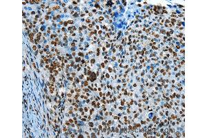 Immunohistochemistry of Human cervical cancer using CREB1 Polyclonal Antibody at dilution of 1:30 (CREB1 anticorps)