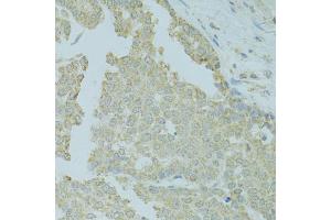 Immunohistochemistry of paraffin-embedded human colon carcinoma using MTFP1 antibody (ABIN5975088) at dilution of 1/100 (40x lens). (Mtfp1 anticorps)