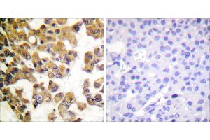 Peptide - +Immunohistochemistry analysis of paraffin-embedded human breast carcinoma tissue using BAD antibody. (BAD anticorps  (Internal Region))
