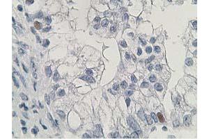 Immunohistochemical staining of paraffin-embedded Adenocarcinoma of Human ovary tissue using anti-HDHD2 mouse monoclonal antibody. (HDHD2 anticorps)