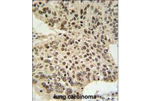 HIST1H2AL Antibody IHC analysis in formalin fixed and paraffin embedded human lung carcinoma followed by peroxidase conjugation of the secondary antibody and DAB staining. (HIST1H2AL anticorps  (C-Term))