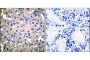 Immunohistochemistry analysis of paraffin-embedded human breast carcinoma tissue, using Transglutaminase 2 Antibody. (Transglutaminase 2 anticorps  (AA 1-50))