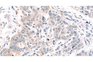 Immunohistochemistry of paraffin-embedded Human lung cancer tissue using ROR1 Polyclonal Antibody at dilution 1:45 (ROR1 anticorps)