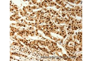Immunohistochemistry of Human breast cancer using C12orf5 Polyclonal Antibody at dilution of 1:80 (TIGAR anticorps)