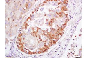 Formalin-fixed and paraffin embedded human lung cancer labeled with Rabbit Anti-S100A4 Polyclonal Antibody, Unconjugated 1:200 followed by conjugation to the secondary antibody and DAB staining (s100a4 anticorps  (AA 15-101))