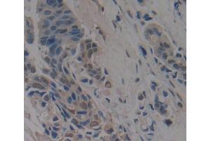 IHC-P analysis of breast cancer tissue, with DAB staining. (Anoctamin 2 anticorps  (AA 823-1003))