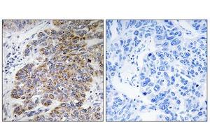 Immunohistochemistry analysis of paraffin-embedded human lung carcinoma tissue, using CHST10 antibody. (CHST10 anticorps  (Internal Region))