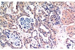 Immunohistochemistry of paraffin-embedded Human breast carcinoma tissue using Bax Monoclonal Antibody at dilution of 1:200. (BAX anticorps)