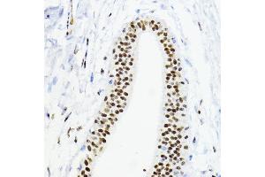 Immunohistochemistry of paraffin-embedded human mammary cancer using ZEB1 antibody (ABIN6129933, ABIN6150422, ABIN6150423 and ABIN6221237) at dilution of 1:200 (40x lens). (ZEB1 anticorps  (AA 1-260))