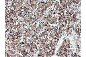 Immunohistochemical staining of paraffin-embedded Carcinoma of Human liver tissue using anti-RPN1 mouse monoclonal antibody. (RPN1 anticorps)