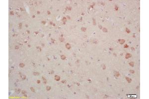 Formalin-fixed and paraffin embedded human gastric carcinoma labeled with Rabbit Anti Annexin A13 Polyclonal Antibody, Unconjugated (ABIN1714416) at 1:200 followed by conjugation to the secondary antibody and DAB staining (CRY1 anticorps)