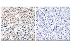 Immunohistochemical analysis of paraffin-embedded human breast carcinoma tissue using p27Kip1(Phospho-Thr187) Antibody(left) or the same antibody preincubated with blocking peptide(right). (CDKN1B anticorps  (pThr187))